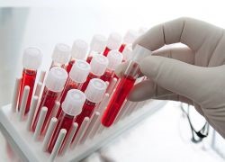 Почему бывает высокий билирубин в крови? Почему бывает высокий билирубин в крови?