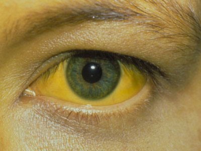 Почему бывает высокий билирубин в крови? Почему бывает высокий билирубин в крови?