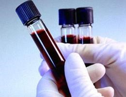 Почему бывает высокий билирубин в крови? Почему бывает высокий билирубин в крови?