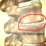 Как улучшить мозговое кровообращение при шейном остеохондрозе Как улучшить мозговое кровообращение при шейном остеохондрозе