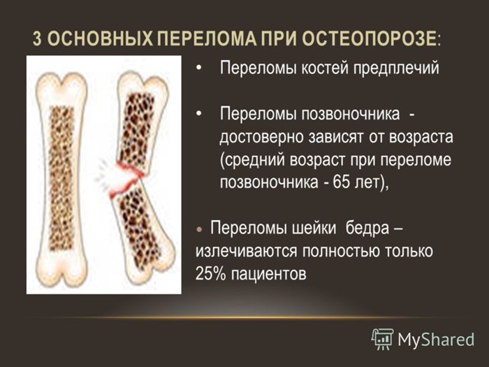 Основные причины возникновения остеопороза Основные причины возникновения остеопороза