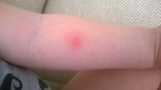 Разрешено ли гулять после пробы Манту? Разрешено ли гулять после пробы Манту?