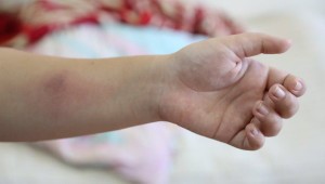 Все об отрицательной реакции на Манту у детей Все об отрицательной реакции на Манту у детей