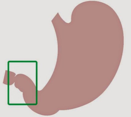 Привратник желудка Привратник желудка