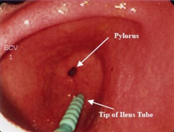 Привратник желудка Привратник желудка