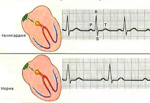 Противопоказания при камнях в почках: чего нельзя, а что можно? Противопоказания при камнях в почках: чего нельзя, а что можно?