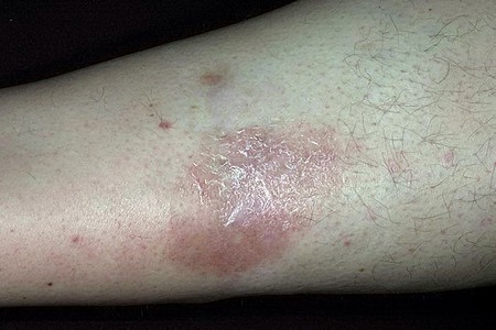 Пятна на ногах при сахарном диабете (красные, коричневые, темные) Пятна на ногах при сахарном диабете (красные, коричневые, темные)