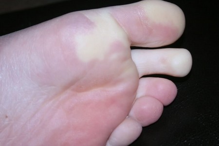 Пятна на ногах при сахарном диабете (красные, коричневые, темные) Пятна на ногах при сахарном диабете (красные, коричневые, темные)