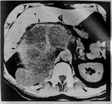 Рак головки поджелудочной: причины, симптомы, лечение Рак головки поджелудочной: причины, симптомы, лечение