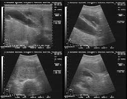 Рак головки поджелудочной: причины, симптомы, лечение Рак головки поджелудочной: причины, симптомы, лечение