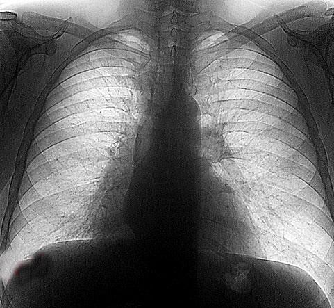 Этиология, клиника и методы терапии аденокарциномы легкого Этиология, клиника и методы терапии аденокарциномы легкого