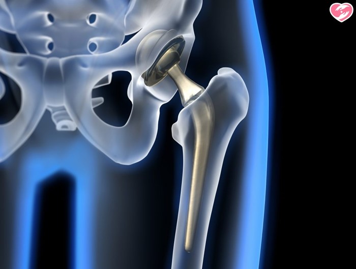 Все про реабилитацию после эндопротезирования тазобедренного сустава: дома и в больнице Все про реабилитацию после эндопротезирования тазобедренного сустава: дома и в больнице