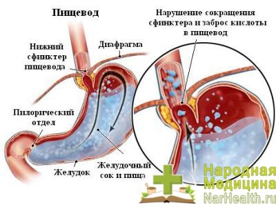Симптомы и лечение рефлюкс эзофагита Симптомы и лечение рефлюкс эзофагита
