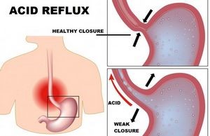 Борьба с рефлюкс-гастритом и его лечение народными средствами Борьба с рефлюкс-гастритом и его лечение народными средствами