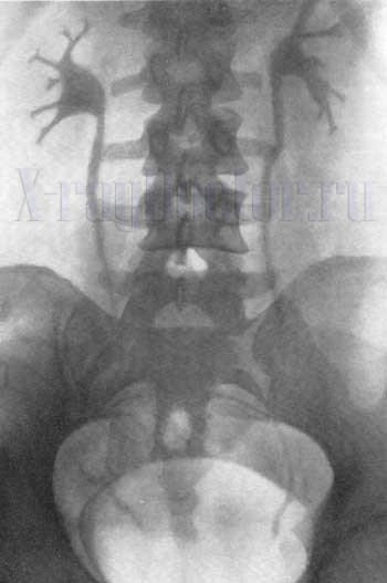 Обследование почек при помощи рентгена Обследование почек при помощи рентгена