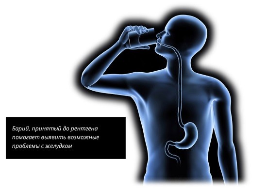 Рентгенография желудка с барием Рентгенография желудка с барием