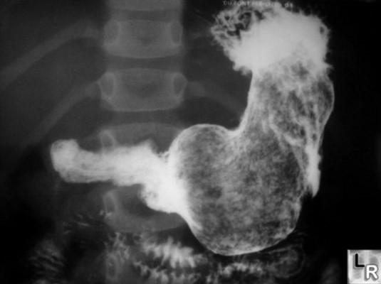 Как проводится рентген кишечника с контрастом (с барием) Как проводится рентген кишечника с контрастом (с барием)