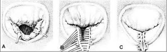 Причины и показания к операции по замене сердечного клапана Причины и показания к операции по замене сердечного клапана