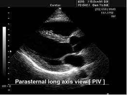 Причины и показания к операции по замене сердечного клапана Причины и показания к операции по замене сердечного клапана
