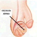 Рак мочевого пузыря Рак мочевого пузыря