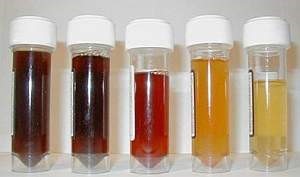 Рак мочевого пузыря Рак мочевого пузыря