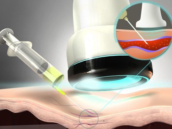 Склеротерапия вен нижних конечностей Склеротерапия вен нижних конечностей