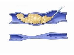 Склеротерапия вен нижних конечностей Склеротерапия вен нижних конечностей