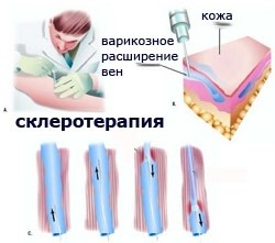 Склеротерапия — безопасный способ лечения варикоза Склеротерапия — безопасный способ лечения варикоза