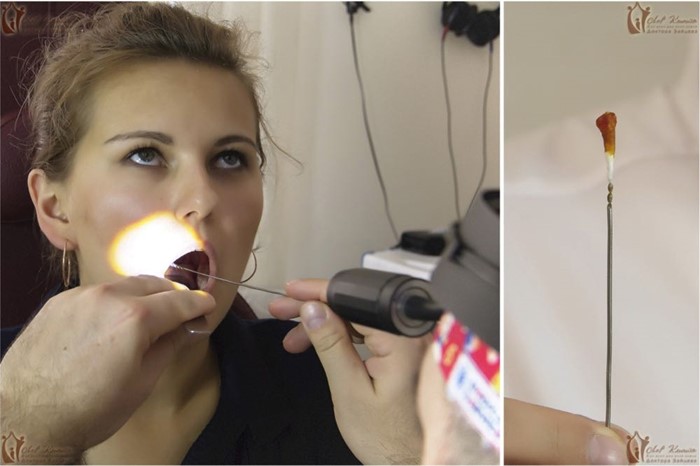 Как лечить хронический тонзиллит хирургически и медикаментозно Как лечить хронический тонзиллит хирургически и медикаментозно