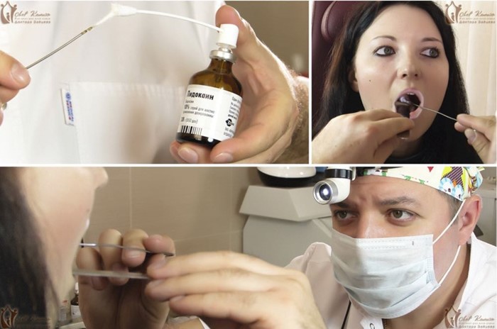 Как лечить хронический тонзиллит хирургически и медикаментозно Как лечить хронический тонзиллит хирургически и медикаментозно