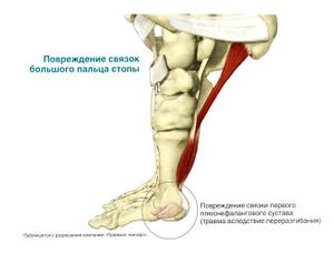Лечение травмы плюснефалангового сустава Лечение травмы плюснефалангового сустава