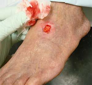 Трофические язвы на ногах в начальной стадии Трофические язвы на ногах в начальной стадии