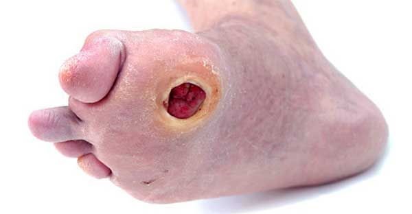 Трофические язвы на ногах в начальной стадии Трофические язвы на ногах в начальной стадии