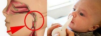 Как убрать сопли из носоглотки ребенка до года? Как убрать сопли из носоглотки ребенка до года?