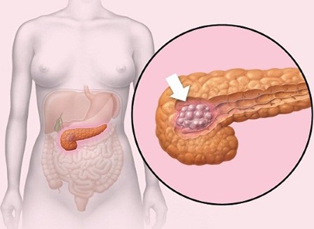 Жизнь после удаления поджелудочной железы Жизнь после удаления поджелудочной железы