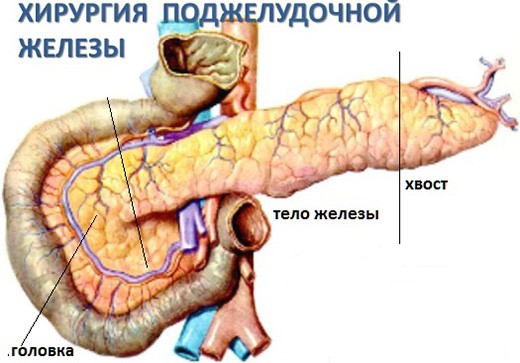 Жизнь после удаления поджелудочной железы Жизнь после удаления поджелудочной железы