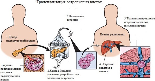 Жизнь после удаления поджелудочной железы Жизнь после удаления поджелудочной железы