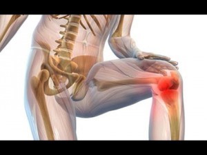 Препараты гиалуроновой кислоты для коленного сустава: обзор уколов для колена, отзывы об инъекциях Препараты гиалуроновой кислоты для коленного сустава: обзор уколов для колена, отзывы об инъекциях