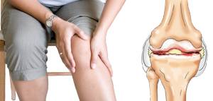 Препараты гиалуроновой кислоты для коленного сустава: обзор уколов для колена, отзывы об инъекциях Препараты гиалуроновой кислоты для коленного сустава: обзор уколов для колена, отзывы об инъекциях