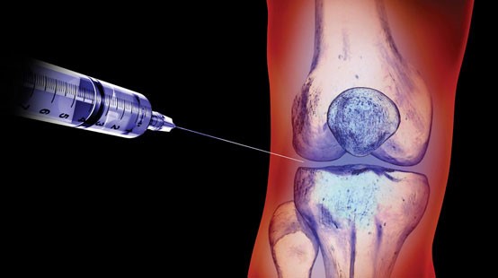 Препараты гиалуроновой кислоты для коленного сустава: обзор уколов для колена, отзывы об инъекциях Препараты гиалуроновой кислоты для коленного сустава: обзор уколов для колена, отзывы об инъекциях