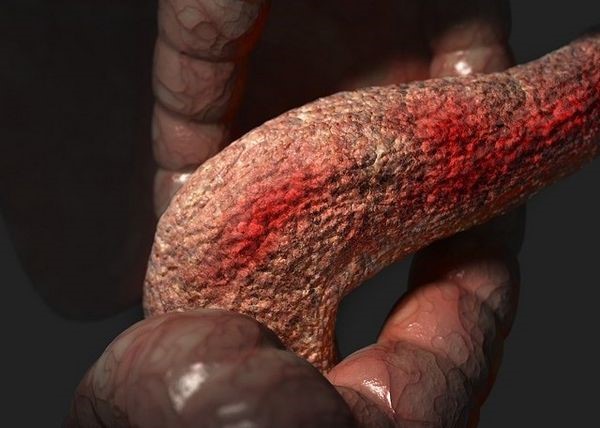 Реактивные изменения поджелудочной железы у ребенка причины Реактивные изменения поджелудочной железы у ребенка причины