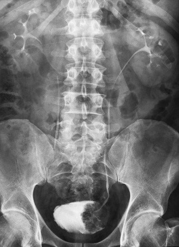 Урография почек с применением контрастного вещества и без: подготовка, отзывы, как проходит Урография почек с применением контрастного вещества и без: подготовка, отзывы, как проходит