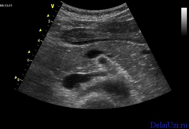 Подготовка к узи поджелудочной железы: нормы размеров у взрослых Подготовка к узи поджелудочной железы: нормы размеров у взрослых