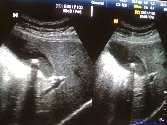 Подготовка к узи поджелудочной железы: нормы размеров у взрослых Подготовка к узи поджелудочной железы: нормы размеров у взрослых