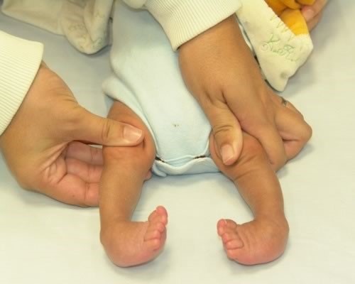 Плоско вальгусная деформация стоп у детей лечение Плоско вальгусная деформация стоп у детей лечение