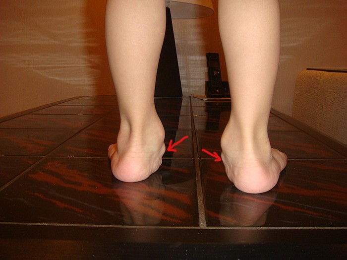 Плоско вальгусная деформация стоп у детей лечение Плоско вальгусная деформация стоп у детей лечение