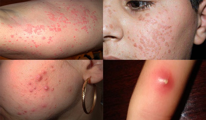 Как выглядит сыпь на кожном покрове при глистах? Как выглядит сыпь на кожном покрове при глистах?