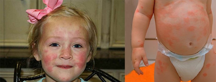 Как выглядит сыпь на кожном покрове при глистах? Как выглядит сыпь на кожном покрове при глистах?