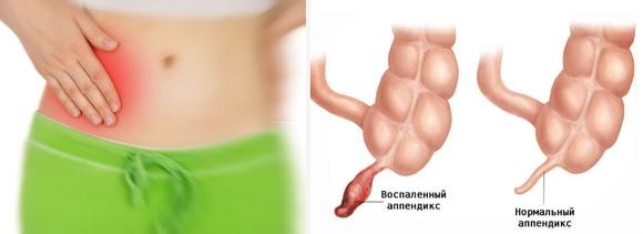 Где находится аппендицит у человека и с какой стороны болит Где находится аппендицит у человека и с какой стороны болит