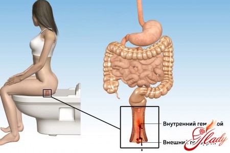 Причины геморроя у женщин, его профилактика и симптомы Причины геморроя у женщин, его профилактика и симптомы